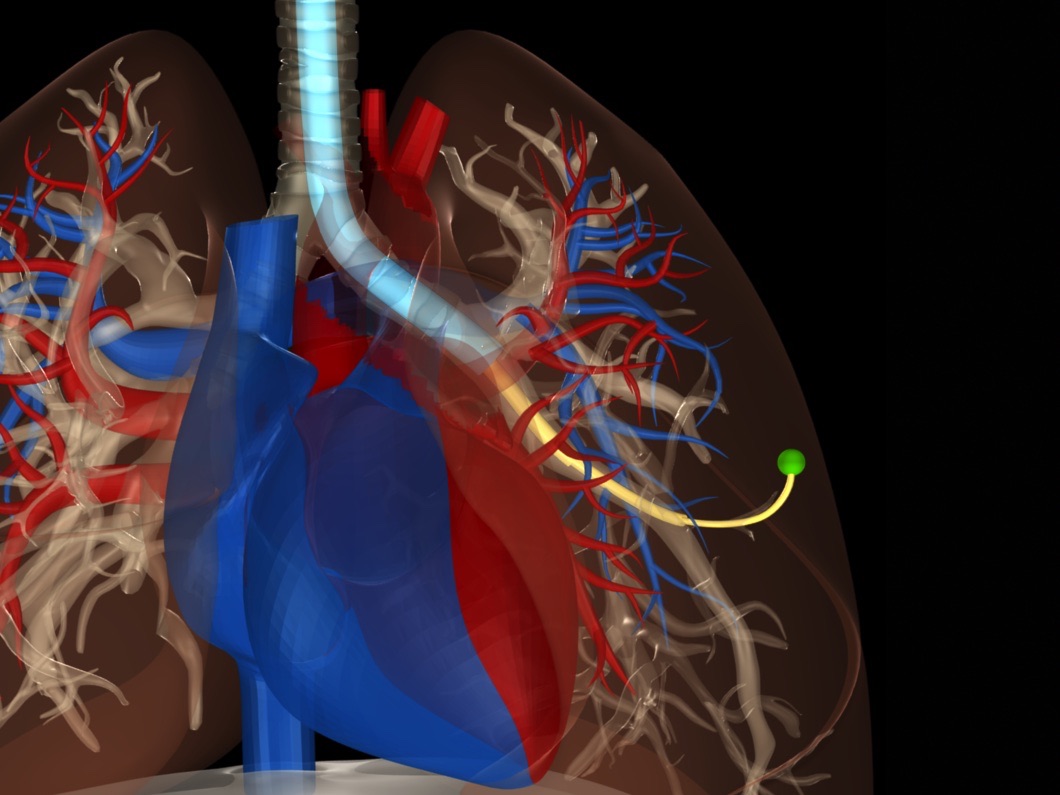 A bronchoscope-deployed steerable needle reaching a suspicious nodule in the lung for biopsy.